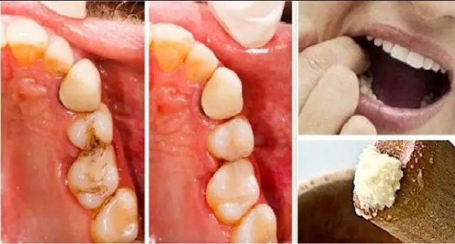 تعرف على فوائد القرنفل للاسنان