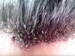 Ikasi emakume ezkondu baten ilean zorrien ametsaren interpretazioa