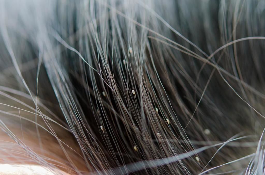 Толкување на сонот за вошки во косата