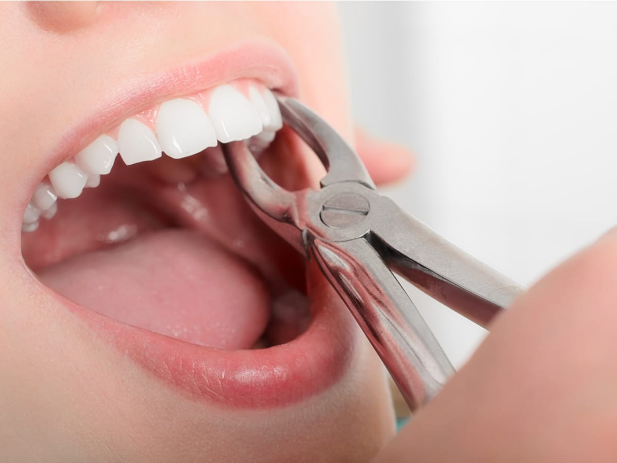 Tumačenje sna o vađenju zuba kada Dr