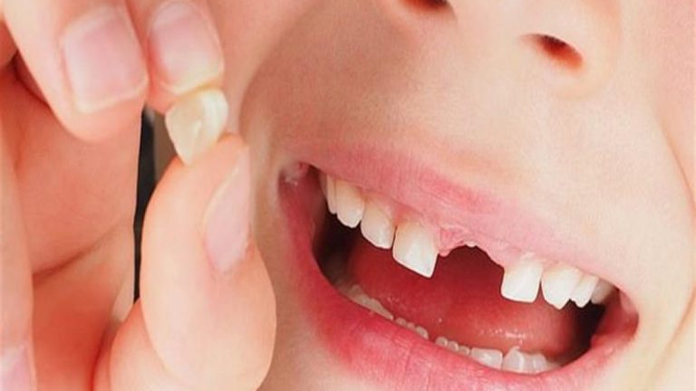 وقوع الأسنان في المنام