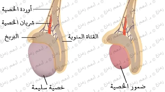 تجربتي مع ضمور الخصية
