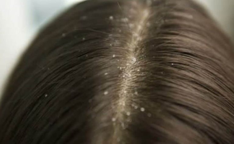 تفسير حلم القملة في الشعر