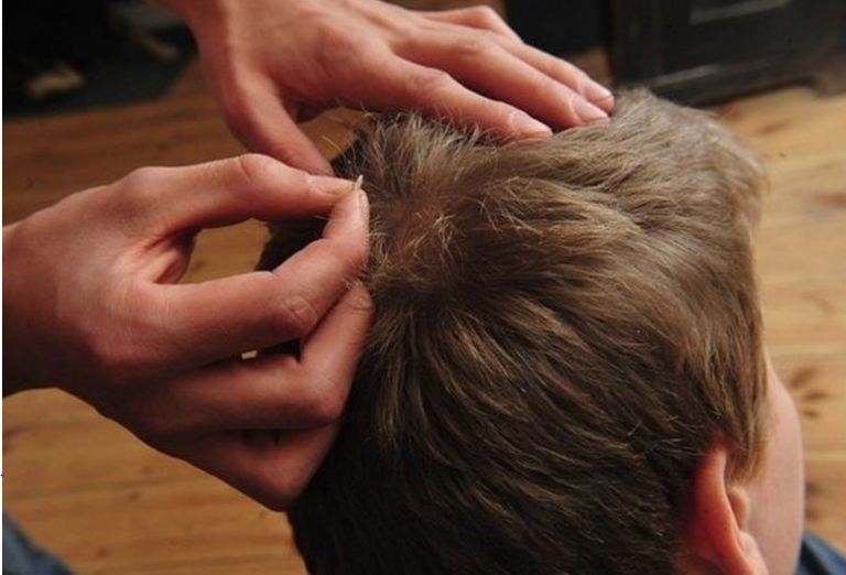 تفسير حلم القمل في الشعر وقتله