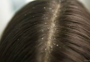 تفسير القمل في الحلم 