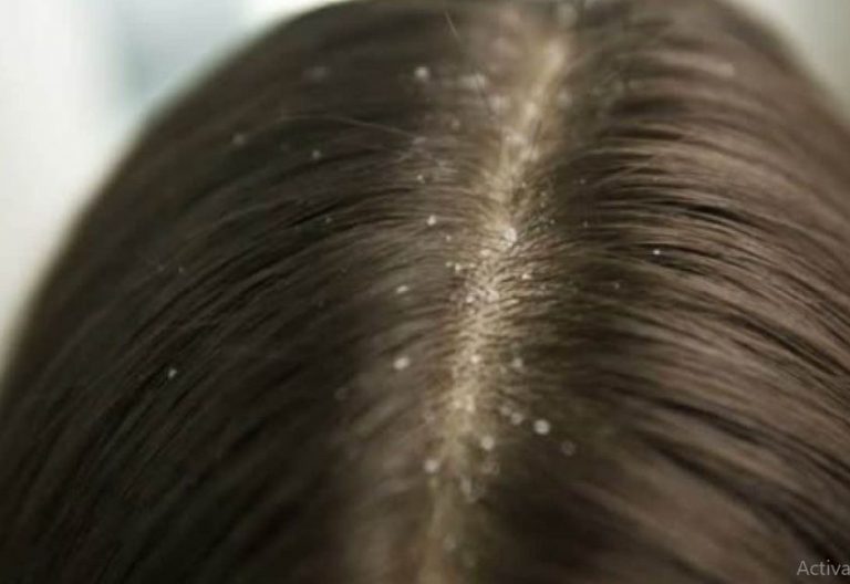 تفسير القمل في الحلم 