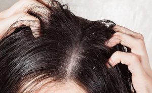 تفسير حلم القمل في الشعر 