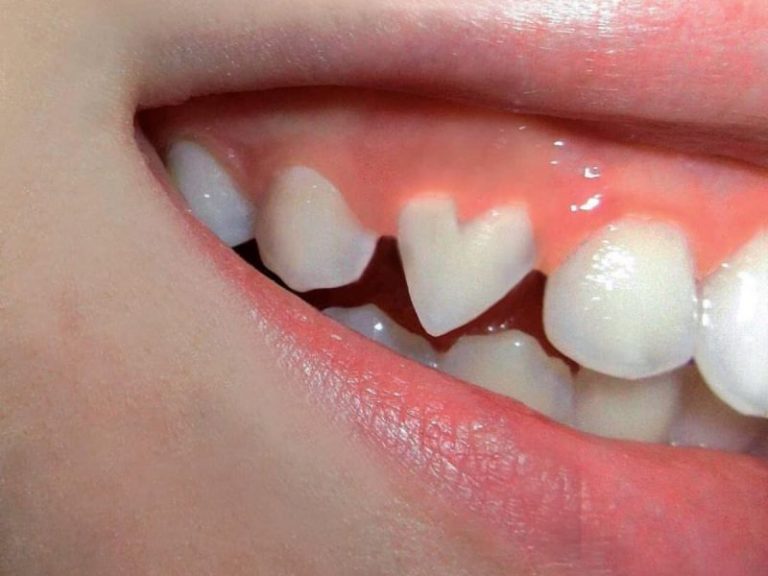 ما تفسير حلم سقوط الاسنان للعزباء