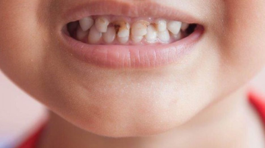 أكثر من 60 تفسير لحلم تسوس الأسنان في المنام لكبار الفقهاء
