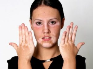 رؤية المرض الجلدي في المنام