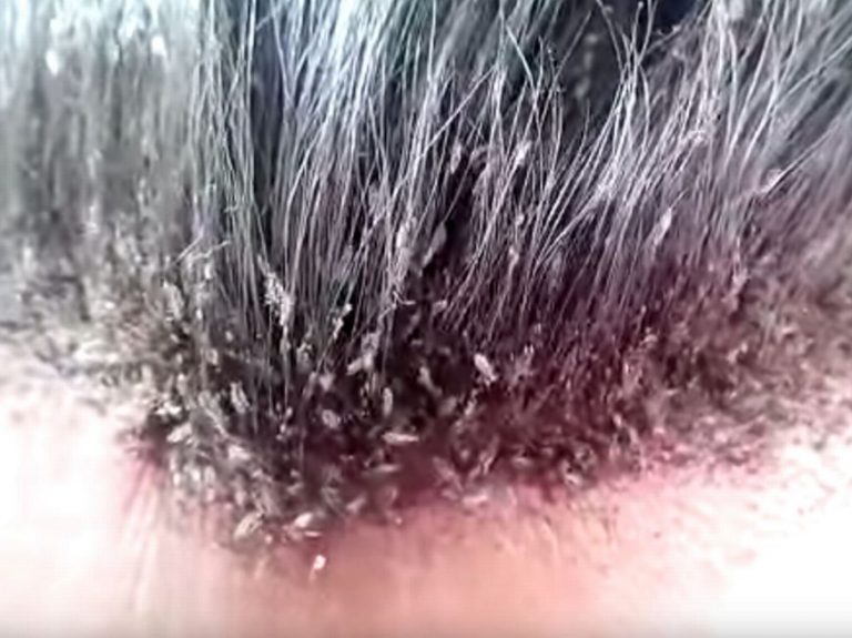 تعرف على تفسير حلم القمل في الشعر للمتزوجة