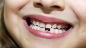 تفسير حلم تساقط الأسنان