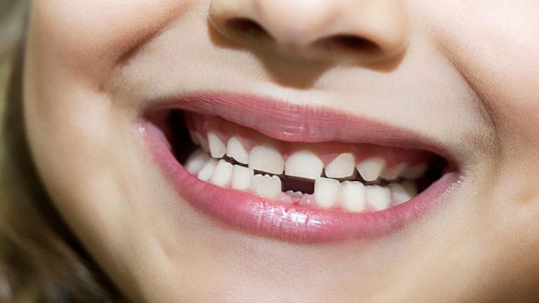 تفسير حلم تساقط الأسنان