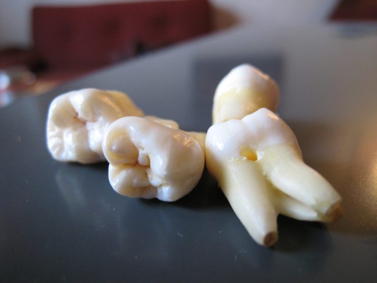 تفسير حلم خلع الضرس العلوي في المنام